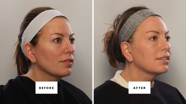 a woman in her 40s before and after 8 treatments to lift her eyelids without a blepharoplasty