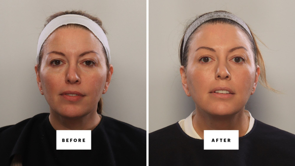 Can You Fake a Blepharoplasty? I Gave It My Best Shot.